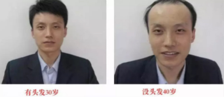 头皮一根皱，脸上六条纹，头皮管理一定要经常做！