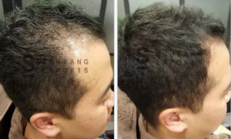 头皮一根皱，脸上六条纹，头皮管理一定要经常做！