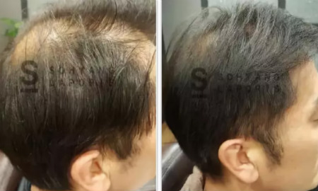 头皮一根皱，脸上六条纹，头皮管理一定要经常做！