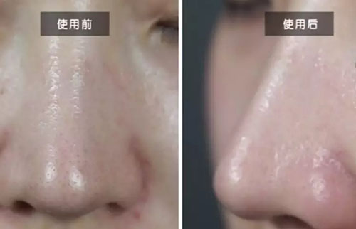 New&New|焕颜美容仪爆款去黑头神器！3分钟搞定多年顽固黑头！