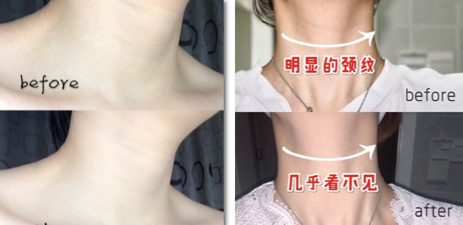 颈部管理功效